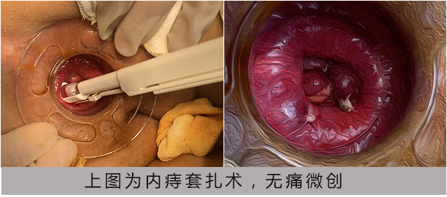 内痔套扎术.jpg