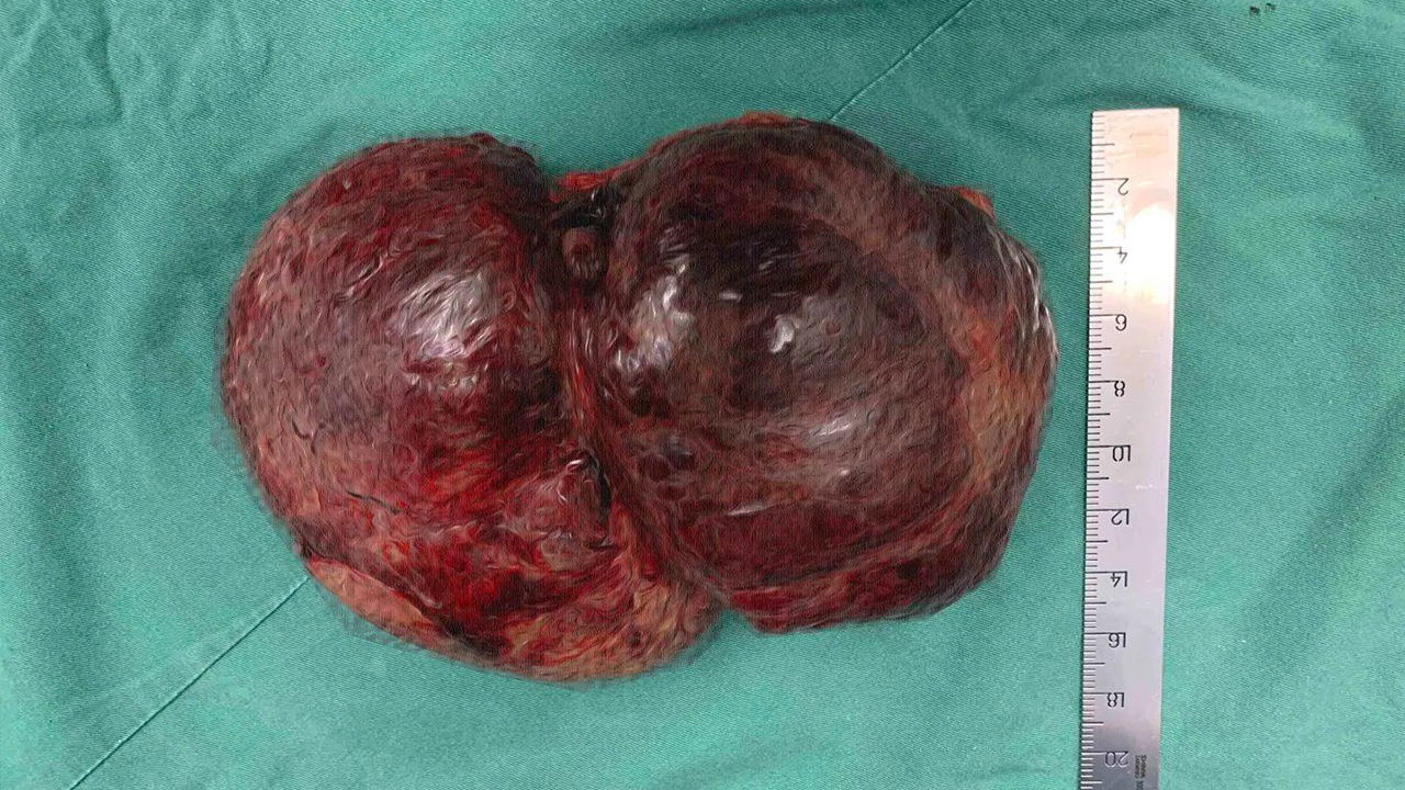 聚焦前沿 | 罕见巨大 多科联手成功完成一例腹腔肿瘤切除术