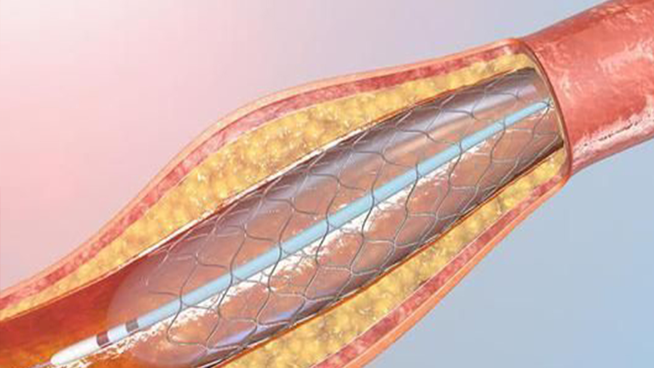 国家组织冠脉支架集采接续采购开标，价格总体平稳—— 产品更加丰富  供应更