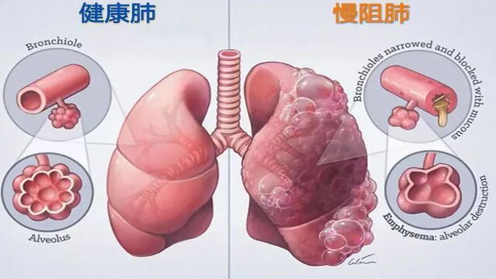 【医院动态】了解你的肺功能